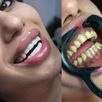 کامپوزیت دندان با تخفیف ویژه فقط تا پایان هفته