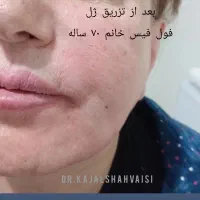 مطب زیبایی دکتر کژال شاه ویسی تزریق ژل بوتاکس..|خدمات آرایشگری و زیبایی|سنندج, |دیوار