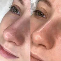 تخفیف تکرار نشدنی پکیج پاکسازی پوست صورت|خدمات آرایشگری و زیبایی|شوشتر, |دیوار
