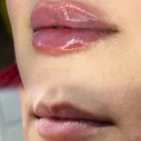 تزریقات ژل .بوتاکس .آنزیم .مزو ژل .مزوسر ضمانتی|خدمات آرایشگری و زیبایی|خرم‌آباد, |دیوار