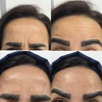 لیزر شاتی الکساندرایت نابلکس بوتاکس فیلر ژل نخ و .|خدمات آرایشگری و زیبایی|تهران, مشیریه|دیوار