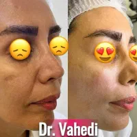 تخفیف ویژه لیفت و جوانسازی صورت|خدمات آرایشگری و زیبایی|مشهد, چهارچشمه|دیوار