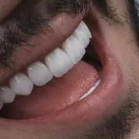 جشنواره تخفیف ایمپلنت در تبریز با اقساط بلند مدت|خدمات آرایشگری و زیبایی|آذرشهر, |دیوار