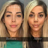 ژل،فیلر،بوتاکس،مزوتراپی با تخفیف‌های باورنکردنی|خدمات آرایشگری و زیبایی|تهران, جماران (نیاوران)|دیوار