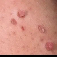 کرم زگیل ومیخچه