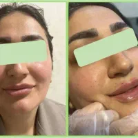 فیلرلب/ژل لب/توسط پزشک/انواع مدل ژل لب|خدمات زیبایی و سلامت|مشهد, عامل|دیوار