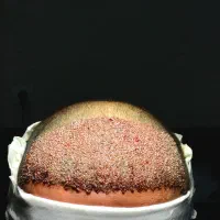 کاشت مو تخصصی در اردبیل|خدمات آرایشگری و زیبایی|اردبیل, |دیوار