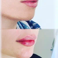 تخفیف عیدانه تزریق ژل،بوتاکس،فشیال.لیزر|خدمات آرایشگری و زیبایی|تهران, نیروی هوایی (پیروزی)|دیوار