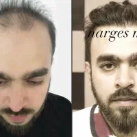 تو‌شهریور کاشت مو‌ هم‌جشنواره هم چکی فقط با ۱۵ ت|خدمات آرایشگری و زیبایی|تهران, جردن|دیوار