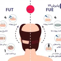 کاشت مو/پیوند مو/کاشت ابرو/کاشت ریش|خدمات آرایشگری و زیبایی|شیراز, وحدت|دیوار