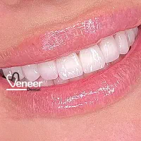 دندانیزشکی کامپوریت لمینت اینیلنت|خدمات آرایشگری و زیبایی|تهران, قیطریه|دیوار