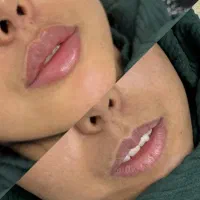 ژل لب ۷۵۰بوتاکس چشم اهویی ۶۵۰ توسط پزشک متخصص