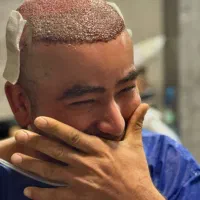 کاشت مو در بانه فقط ده میلیون