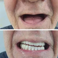 دندان مصنوعی|خدمات آرایشگری و زیبایی|آبیک, |دیوار