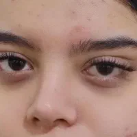 کاشت هیدن