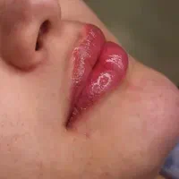 تخفیف ویژه ژل و فیلر|خدمات آرایشگری و زیبایی|گلبهار, شهر جدید گلبهار|دیوار