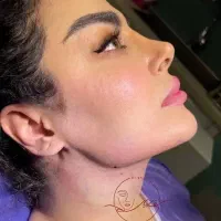 ساکشن غبغب وی لاین عمل جراحی سوپرکانتور لیپوفیس