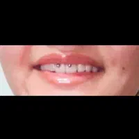 تخفیف ویژه سوراخ کردن گوش و پیرسینگ در مطب اردبیل|خدمات آرایشگری و زیبایی|اردبیل, |دیوار