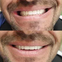 دندان مصنوعی با ظاهری کاملا طبیعی