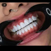 تخفیف ایمپلنت و کامپوزیت فقط با 10 تومن