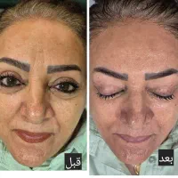 فیشیال تخصصی پوست آقایان و خانم ها