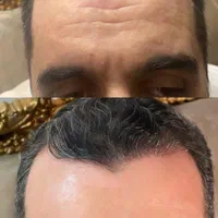 تزریق بوتاکس کل صورت و زیر بغل|خدمات آرایشگری و زیبایی|کرمانشاه, |دیوار