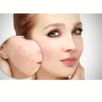 توجه توجه برداشتن خال،کک به صورت کاملا تضمینی