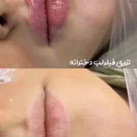 تخفیفات استثنایی ژل و بوتاکس در مطب زیبایی|خدمات آرایشگری و زیبایی|قم, دورشهر|دیوار