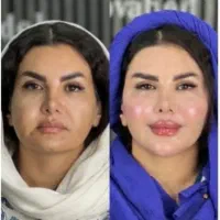 تزریق ژل لب و گونه و چانه.. (جشنواره)درمطب فقط499ت|خدمات آرایشگری و زیبایی|اصفهان, باغ زیار|دیوار