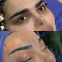جراحی لیفت شقیقه،ابرو،پیشانی آندوسکوپیک/جراحی بینی