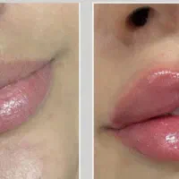 ژل بوتاکس مزوتراپی مو برداشت خال فیشیال