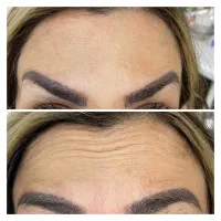 خدمات زیبایی فیلر بوتاکس
