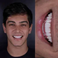 کامپوزیت روکش سرامیکی لمینت ایمپلنت دندانپزشکی