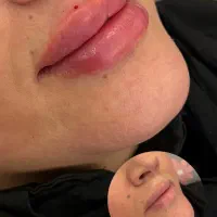 تزریق ژل و بوتاکس فقط۷۵۰|خدمات آرایشگری و زیبایی|هشتگرد, شهرک راه آهن|دیوار