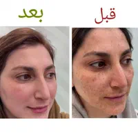 جشنواره درمان تضمینی لک و کک و مک / فقط در 1 جلسه|خدمات آرایشگری و زیبایی|اصفهان, ناژوان|دیوار