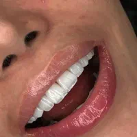 کامپوزیت لبه شیشه ای اقساطی