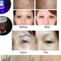 پاک کردن تتو در سه جلسه