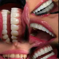 تخفیفات لمینت ،کامپوزیت...