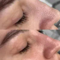 پاکسازی صورت ،فقط۳۰۰ هزار تومان (تماس بگیرید)