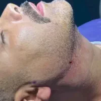 مدل ساکشن غبغب ، بوکال فت،بلفارو ،سانترال لب|خدمات آرایشگری و زیبایی|تهران, چیذر|دیوار
