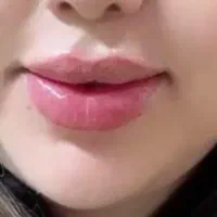 تزریق ژل وبوتاکس|خدمات آرایشگری و زیبایی|شیراز, ریشمک|دیوار