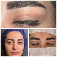 تخفیف عمل پلک و بینی و غبغب و لیپو و ابدو وترانسفر|خدمات آرایشگری و زیبایی|ورامین, ورامین|دیوار