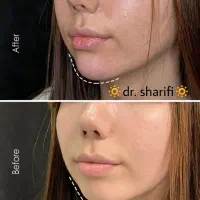 جشنواره ۵۰ درصدی ژل و بوتاکس توسط جناب دکتر شریفی