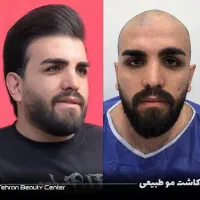/ کاشت مو و ابرو /بلفارو/ /عمل بینی ژل وبوتاکس|خدمات آرایشگری و زیبایی|تهران, دکتر هوشیار|دیوار