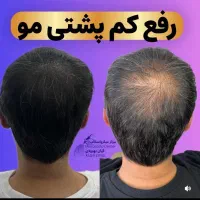 شبیه سازی فولیکول مو smp اس کالپ|خدمات آرایشگری و زیبایی|دوگنبدان, |دیوار