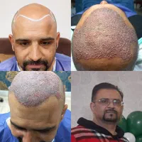 کاشت مو