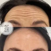 جشنواره تخفیف ژل بوتاکس مزو آنزیم فیلر غبغب