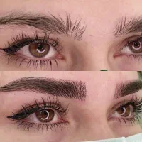 %میکروبلید فیبروز کرکی مویی روش جدیدزیر قیمت%