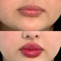 ژل بوتاکس فیلر زاویه سازی خط لبخند لیزر مطب پزشک|خدمات آرایشگری و زیبایی|قم, ارم|دیوار
