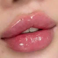 مدل ژل و بوتاکس و چال لپ